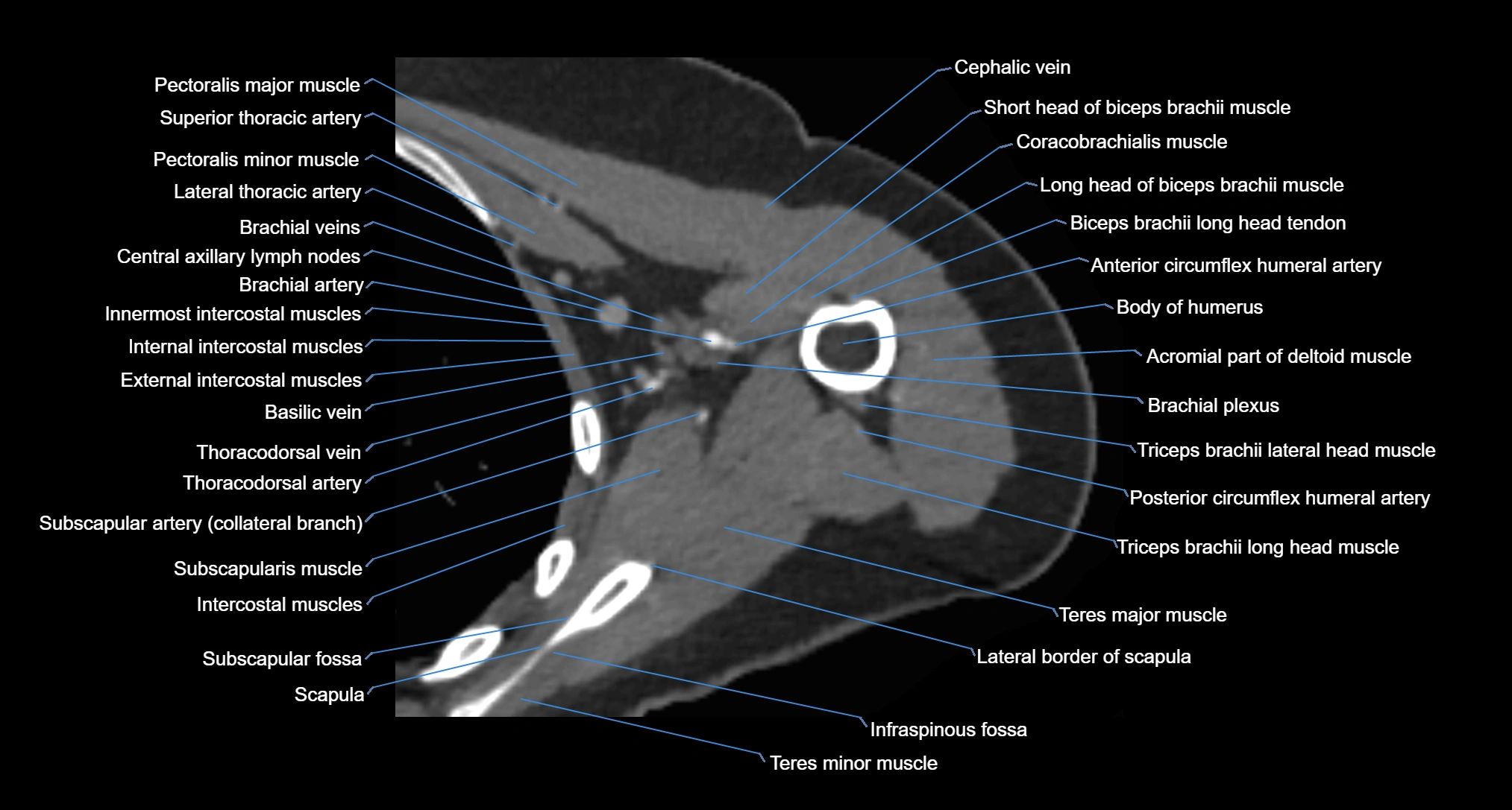 CT Shoulder axial cross sectional anatomy labelled radiology image -00053.webp